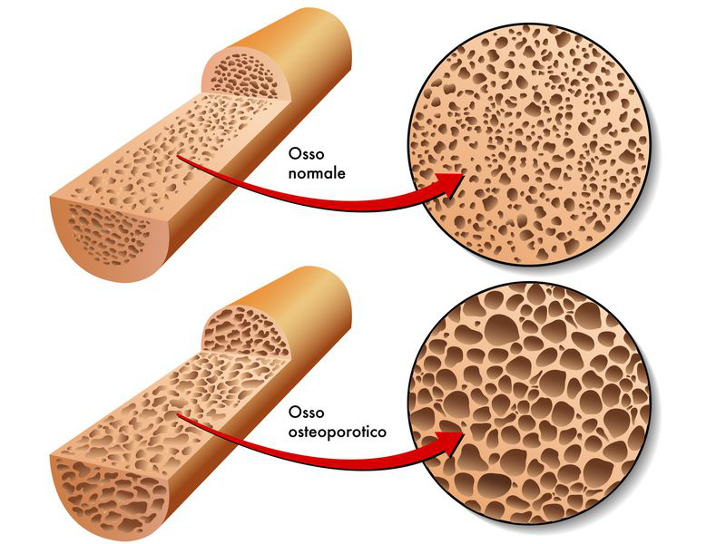 Osteoporosi e malattie croniche infiammatorie intestinali
