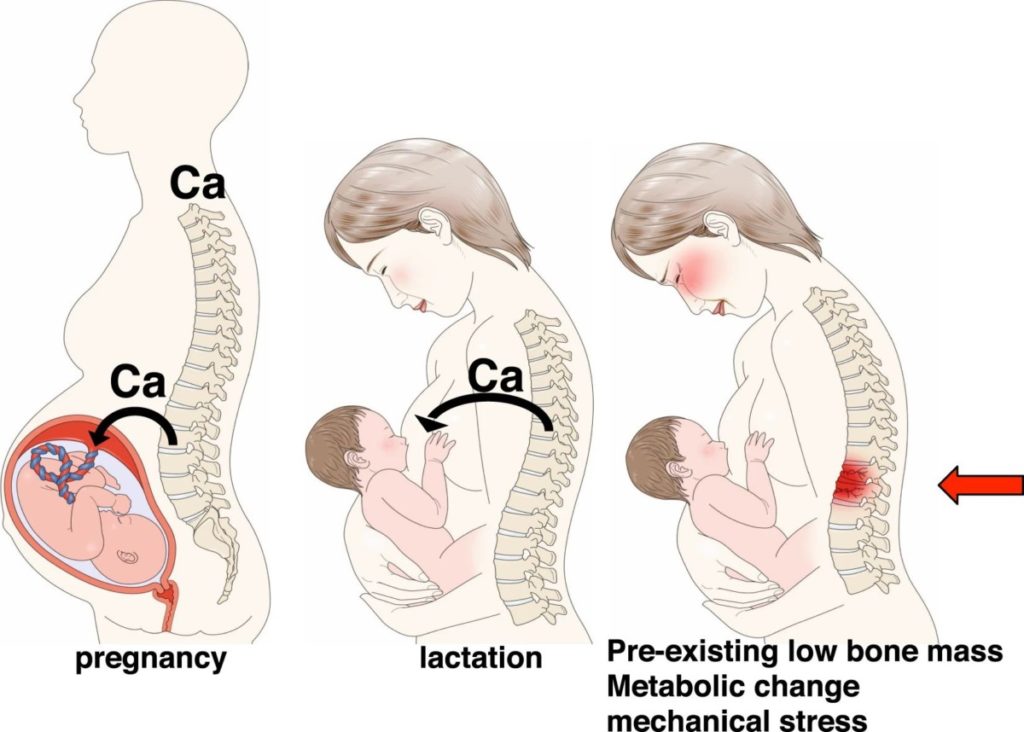 Schema che mostra i meccanismi alla base della fragilità ossea o delle fratture a bassa energia dovute a gravidanza e allattamento.