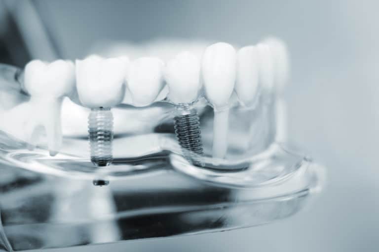 Implant osteo-metabolic screening (IOMS) e osteo-metabolic assessment (OMA)