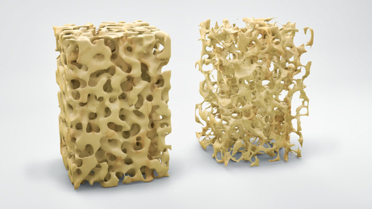 Osteoporosi secondarie