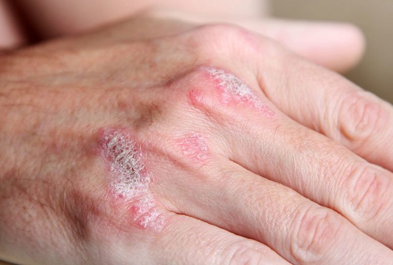 Osteoporosi e psoriasi