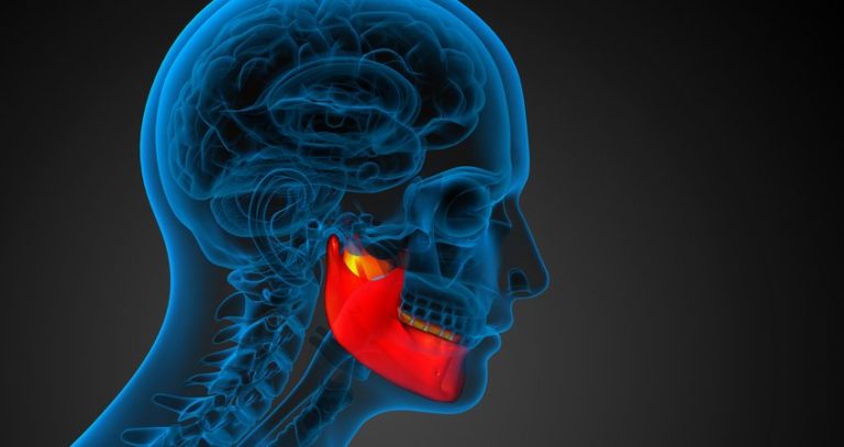 Osteonecrosi dei mascellari correlata ai farmaci nei pazienti oncologici