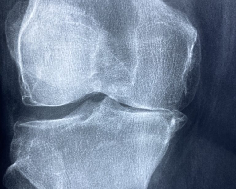Osteonecrosi del ginocchio, quando fare la protesi?