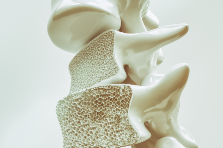 Zoledronato per la prevenzione della perdita di massa ossea nella discontinuazione del denosumab