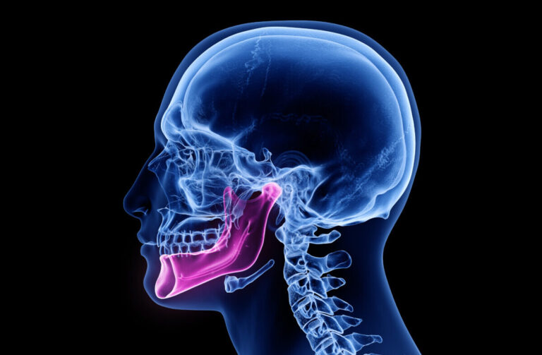 Le fluvastatine nella prevenzione dell’osteonecrosi mascellare