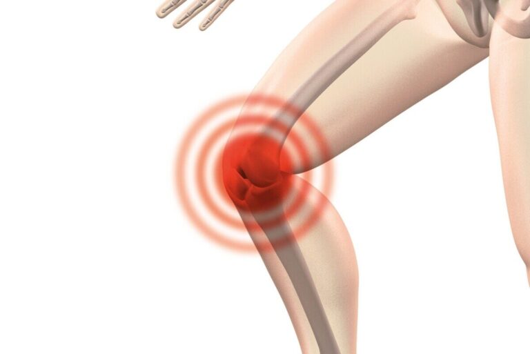 Il rischio di osteoartrosi è correlato alla carenza di vitamina D e alla densità minerale ossea?