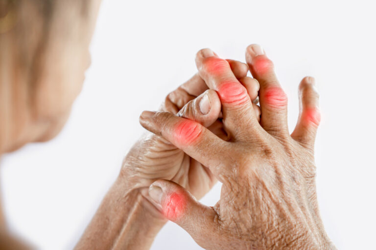 Artrite reumatoide: il trattamento COBRA attenuato è efficace quanto la terapia COBRA e ha effetti avversi ridotti