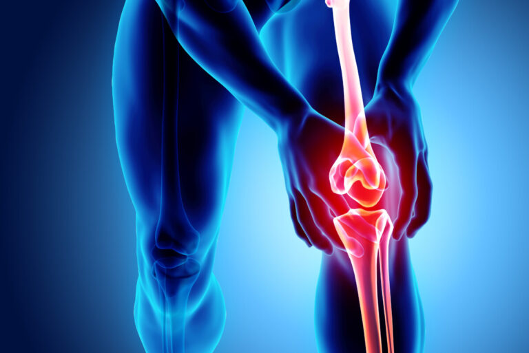 Il trattamento chirurgico dell’edema del midollo osseo del ginocchio