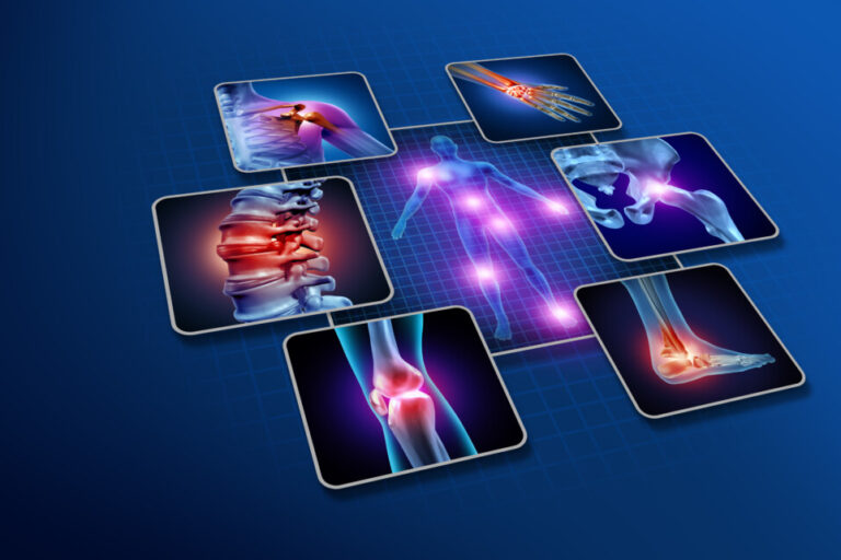 Osteoporosi secondaria
