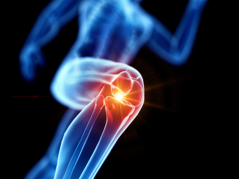 La subcondroplastica nel trattamento dell’edema osseo