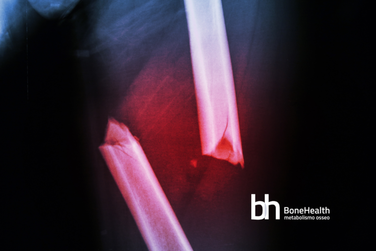Romosozumab e alendronato per osteoporosi post-menopausale