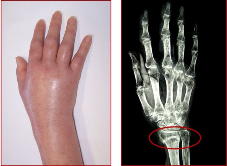 Algodistrofia e osteoporosi regionali