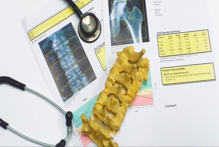 Terapia combinata e sequenziale nell’osteoporosi post-menopausale