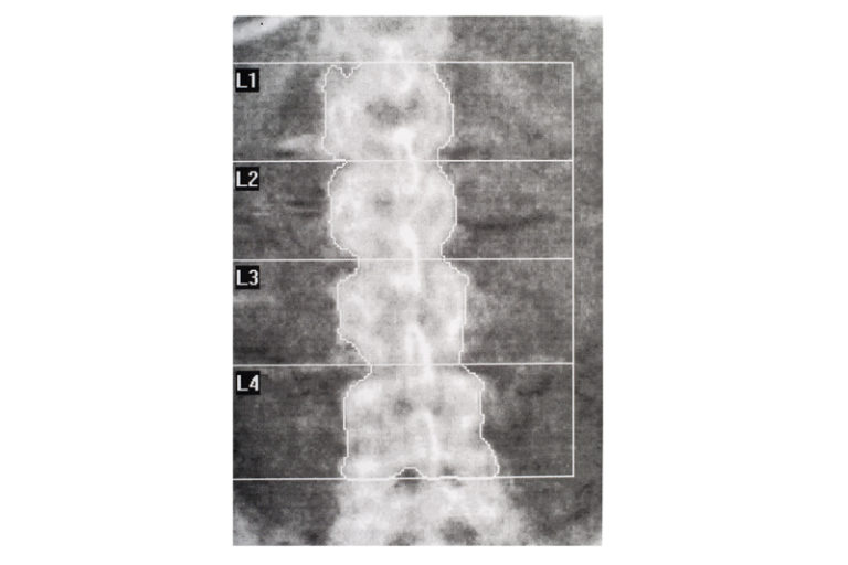 Infezione da HIV: screening osteo-metabolico pre-implantare